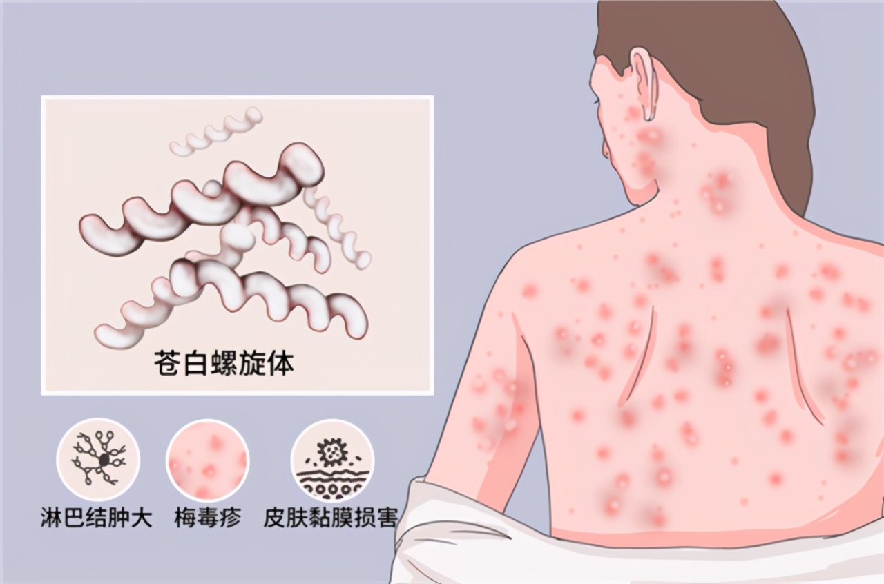 令人"闻风丧胆"的梅毒,患上它之后还能活多久?