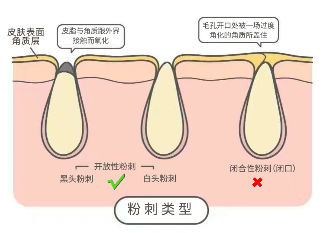 火遍全网的甲硝唑凝胶祛痘去黑头，真有那么香？皮肤医生扒给你看