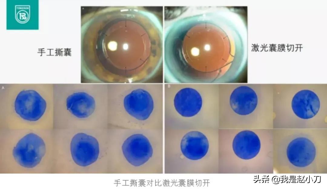 白内障手术贵不贵，晶体怎么选，要不要用飞秒？我来跟你聊一聊