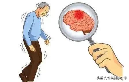 身体僵硬、走着走着就偏了——多系统萎缩，大脑的变性疾病