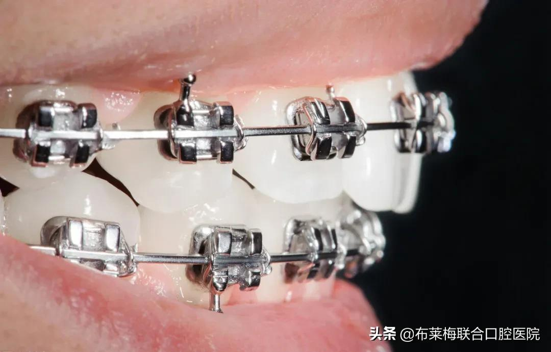 牙齿矫正,你所关心的那些问题