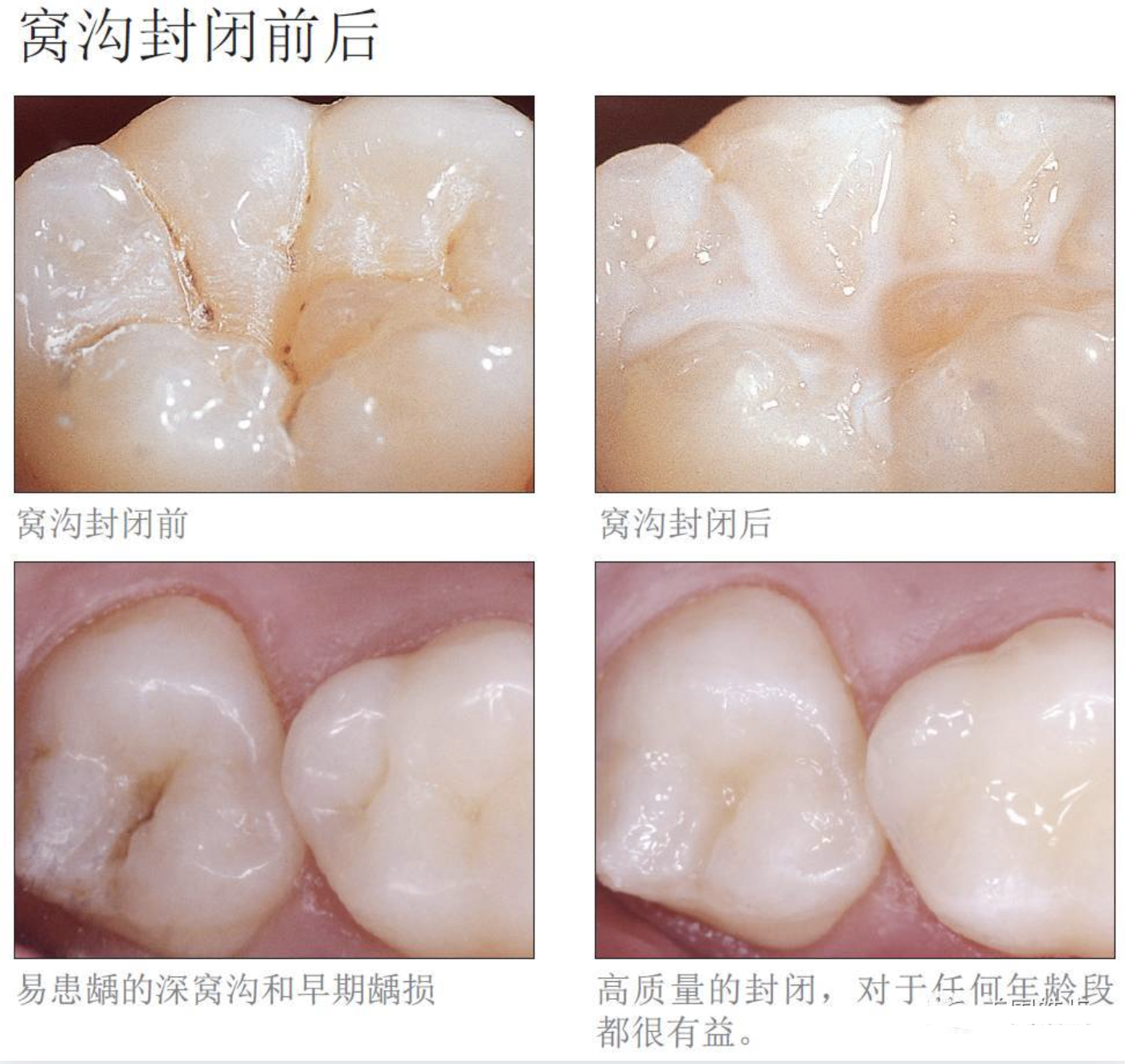 两种公认最有效的儿童防龋方法——涂氟和窝沟封闭，家长建议收藏