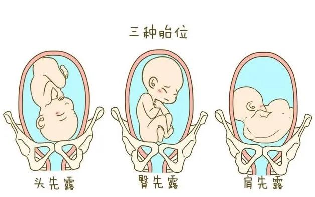 孕29周,宝宝臀位需要纠正吗?