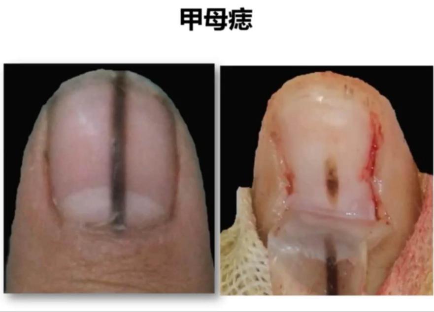 指甲上有条黑线是什么病？甲黑色素瘤or甲母痣？良性还是恶性？