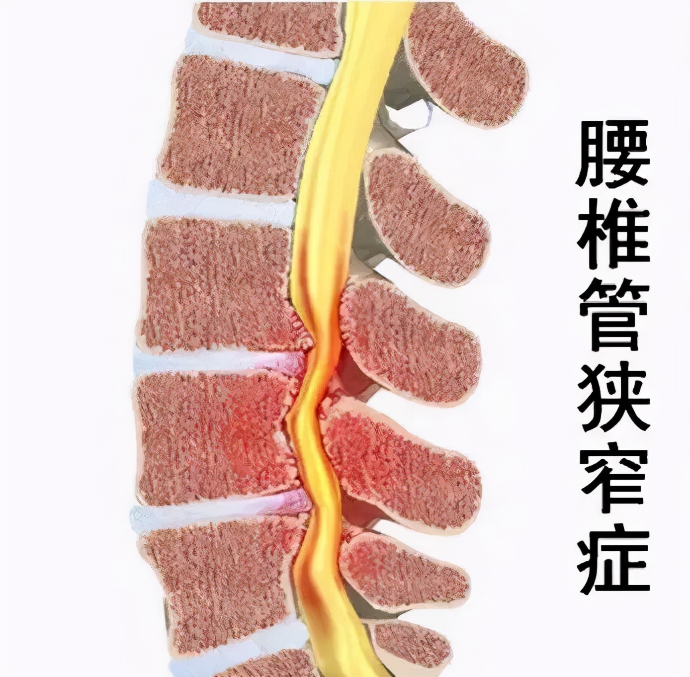 脊柱内“堵车”，跛行、腰痛都会找上门