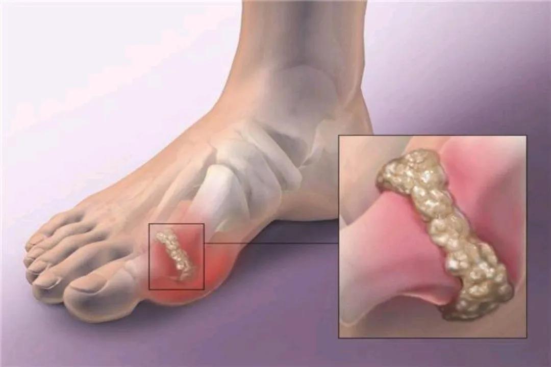 导致痛风发作的诱因,常见的有哪些,能够预防吗?医生为您讲清楚