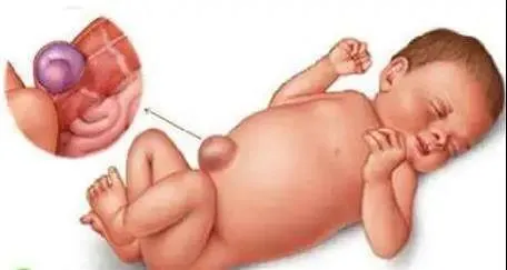 婴儿右下腹部鼓包图片图片