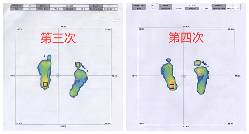 为什么我的孩子有副舟骨疼痛？孩子走路总觉得疲劳是怎么回事？