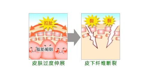 孕期妊娠纹真心伤不起，过来人告诉你：这样处理