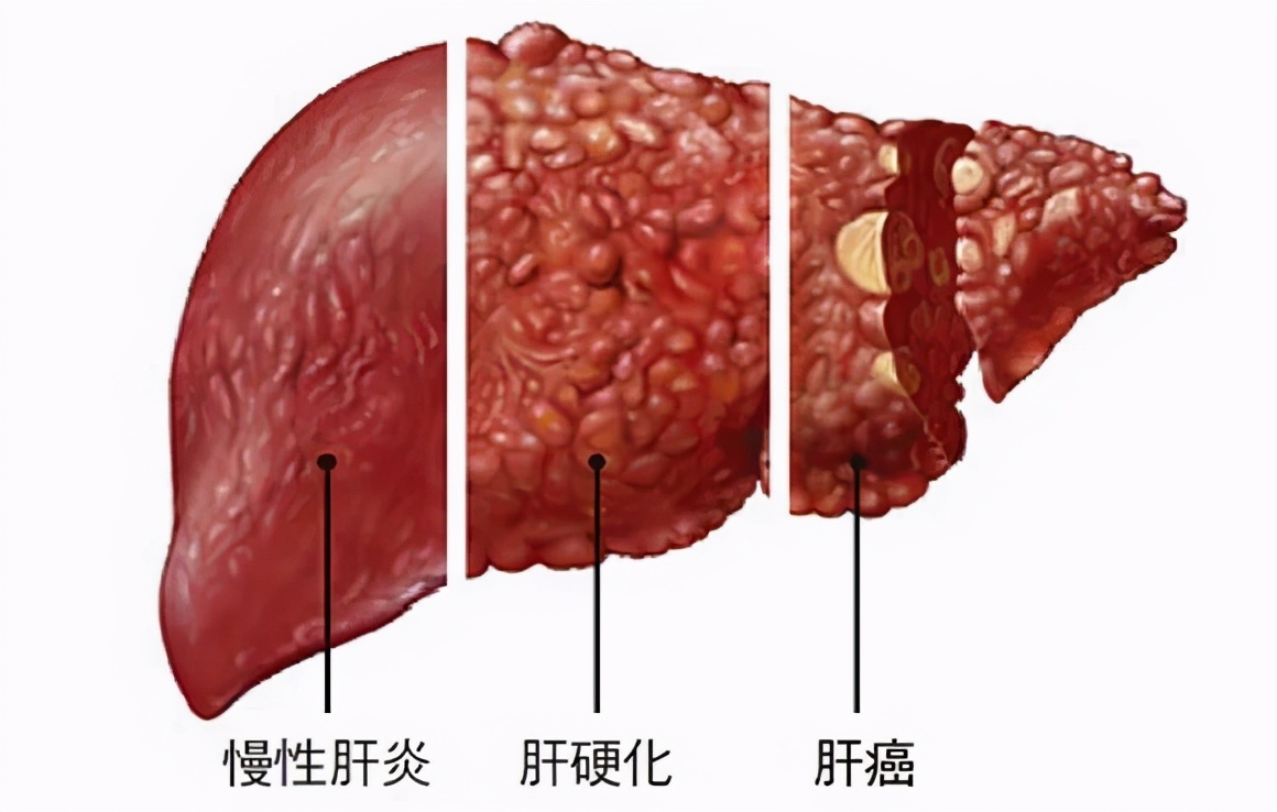 凝血酶原活動度偏高是什麼意思(出現這些症狀) - 百百科