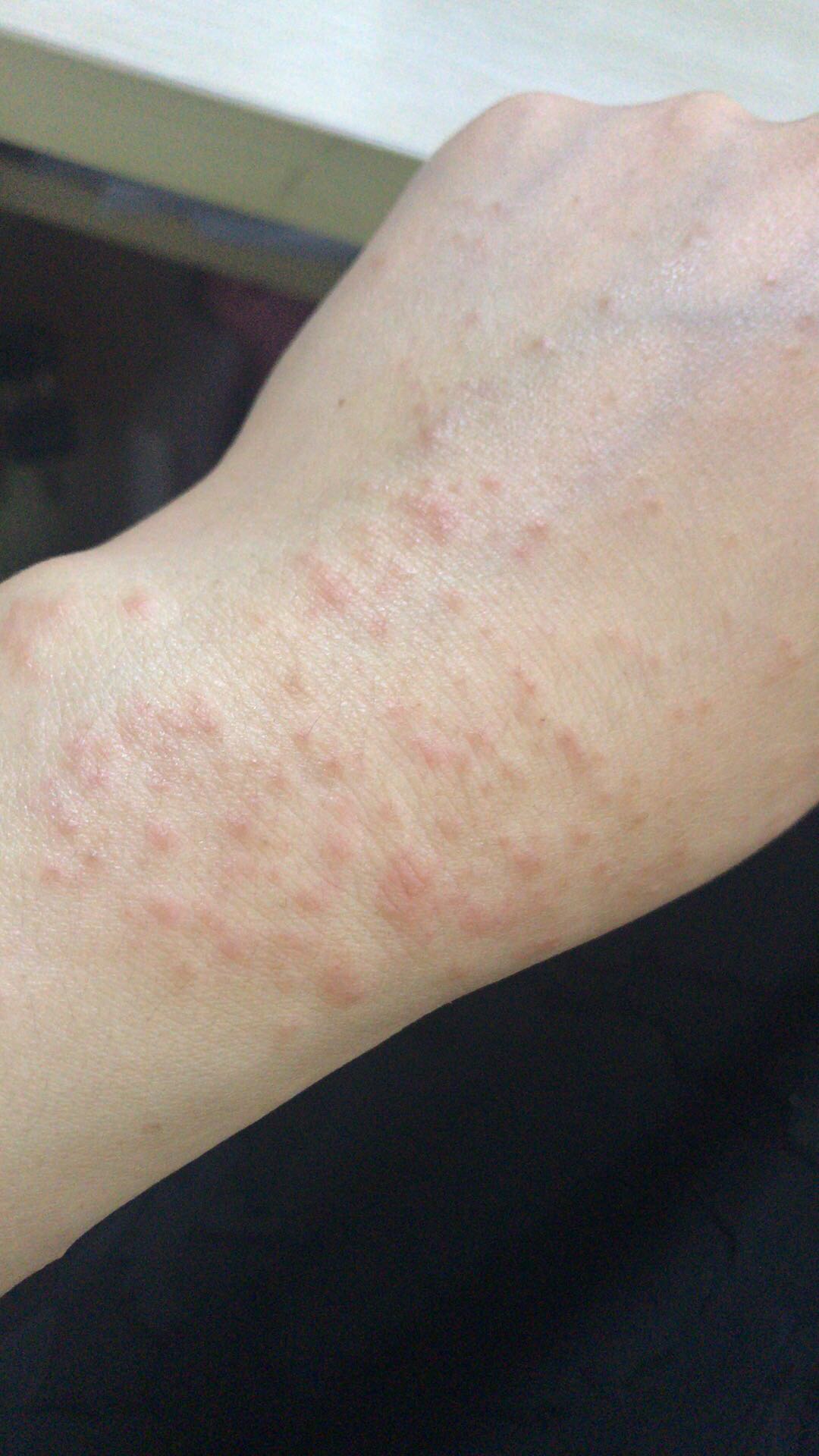 叫了很多年的"湿疹",原来还不是一种病?