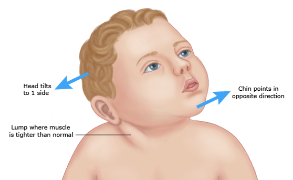 宝宝斜颈的症状图片(路医生说丨小孩脖子是歪的) - 赤虎壹号