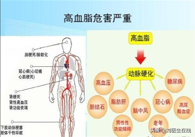 低密度脂蛋白，为什么会高？医生总结：4点主要原因