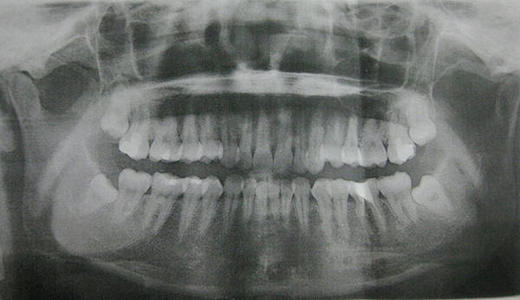 为什么去医院看牙必须要拍牙片？医生：不拍牙片相当于无证驾驶