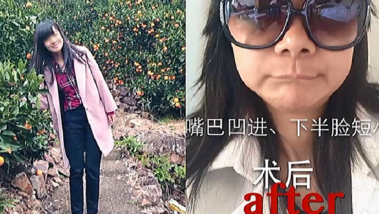 赴韩整容失败示威,赴韩整容失败视频