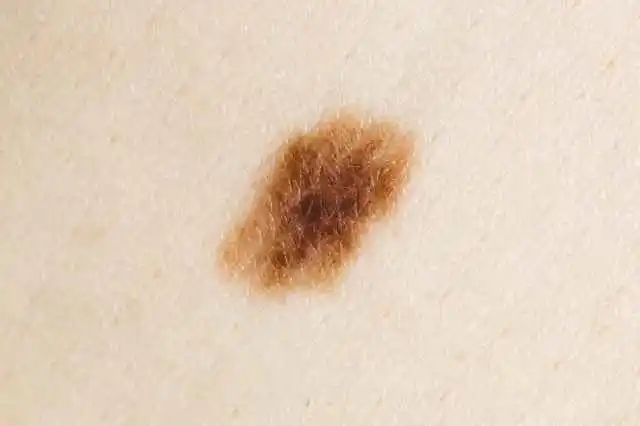 并在其"人生告别会"上奉劝朋友:"要把"美人痣""好吃痣"等痣全部切掉