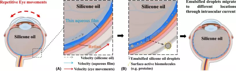 硅油是啥，硅油在玻璃体视网膜手术中的应用？