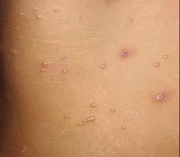 1,皮赘皮赘不会传染,而且是良性病变,没有癌变可能,但如果是较大的,在