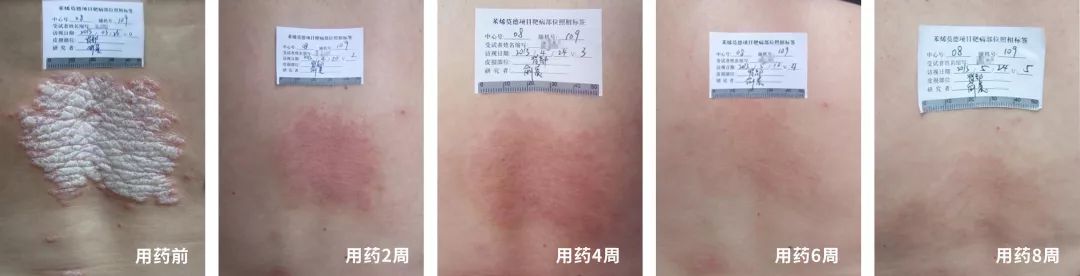 银屑病重磅新药欣比克，使用后的效果究竟怎么样？临床数据告诉你