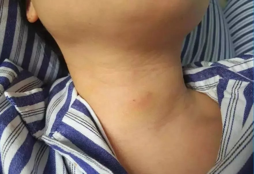 43岁大姐脖子疼,甲状腺结节恶化,提醒:如果3点不适,早去医院