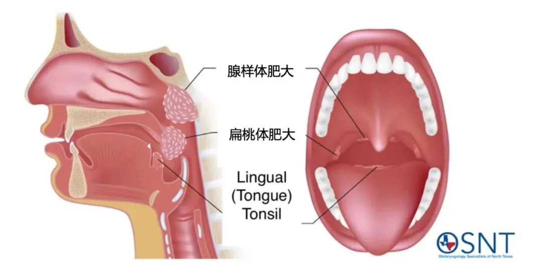 孩子打呼、张口呼吸，腺样体肥大要手术么？术后抵抗力会变差吗？