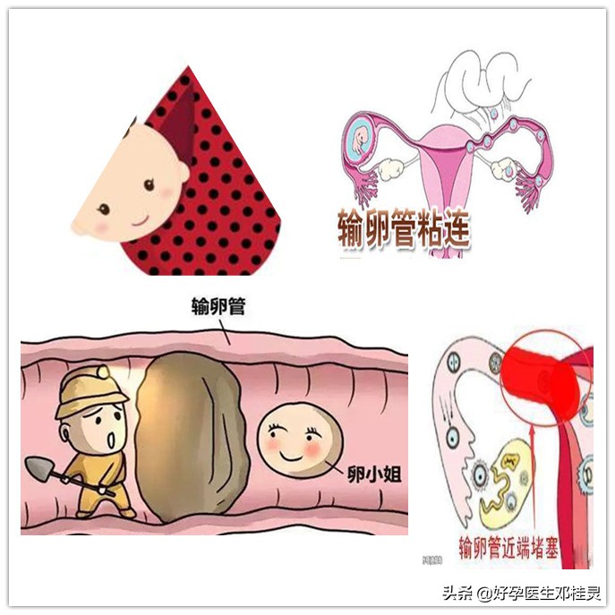 检查输卵管是否畅通只能做造影吗？造影疼不疼？有啥需要注意的？