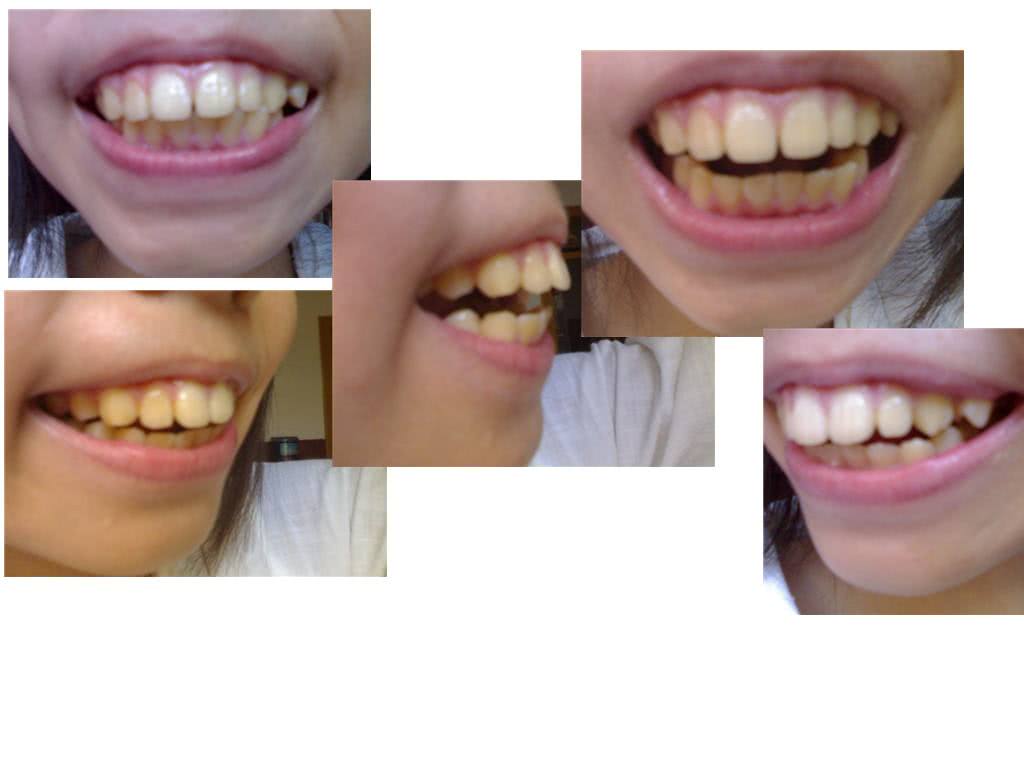 “龅牙”是什么？通过矫正可以恢复吗？