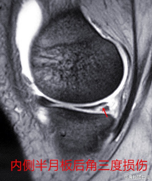 膝盖疼，诊断为半月板撕裂，还能恢复好吗？听听骨科医生怎么说！