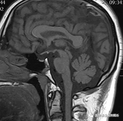 垂体柄阻断综合征并股骨头骨骺滑脱MR典型影像表现及分析思路