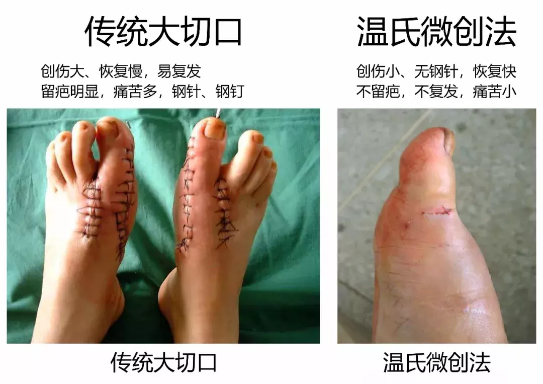 案例:轻度拇外翻不治疗,拖延20年成重度,疼痛难忍才来手术