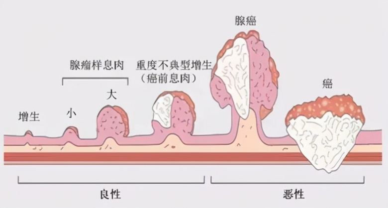 发现肠息肉  一定要切除吗？杨大夫有话说