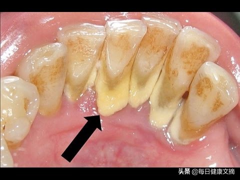 结石通常是由食物残渣,唾液和口腔中的细菌引起的.