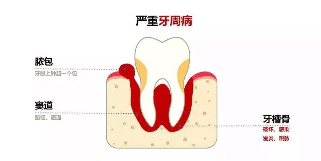 牙龈脓包怎么回事？