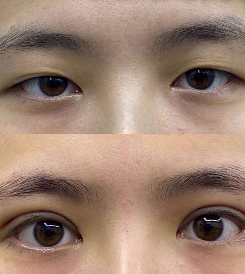 上眼睑肌发育不良,退化松弛或遗传所造成的眼部问题