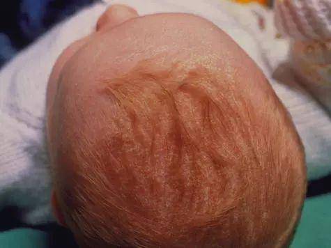 三个月婴儿头垢图片