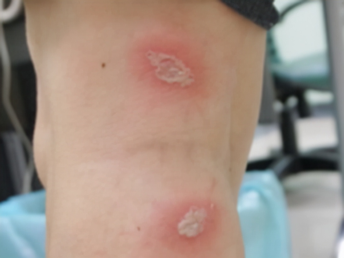 被隐翅虫咬伤急救指南,毒液酸性或可堪比硫酸?