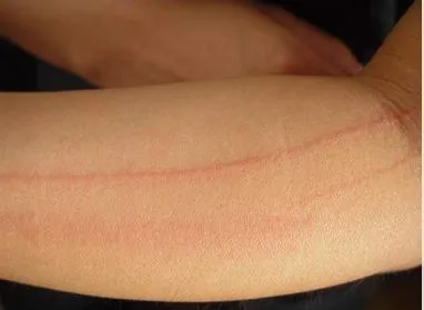 “荨麻疹”多次口服氯雷他定仍反复发作，看看如何中医快速辨治