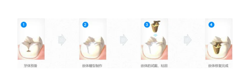 嵌体补牙价格，相对于补牙，嵌体修复的优势在哪里