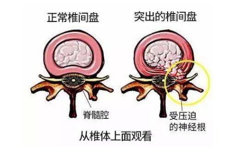 解答，椎间盘突出患者微创手术最关心的六大疑问