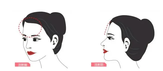 同样丰额头,哪种材料效果更好?