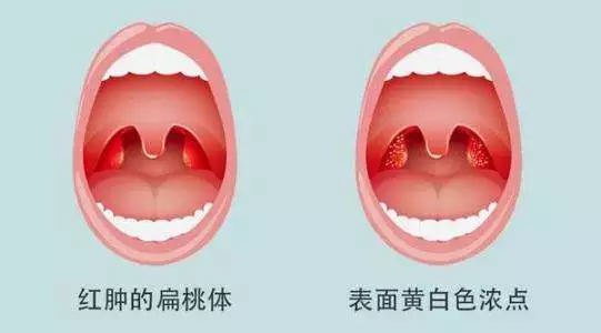 别拿扁桃体发炎不当回事？扁桃体发炎、上火了怎么治