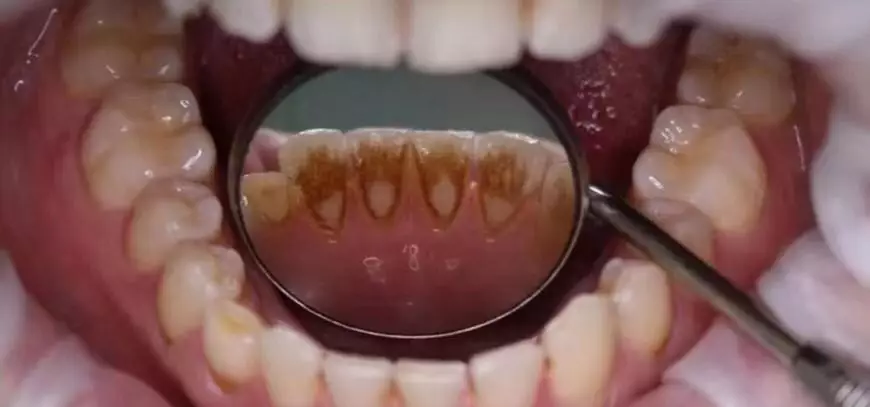关于「洗牙」网友问得最多最奇葩的20个问题！涨知识