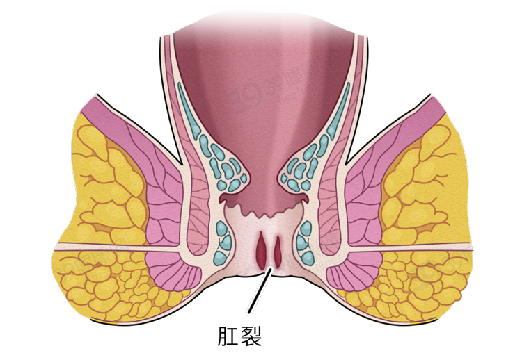 肛裂是一种怎样的体验？5个行为是肛裂“根源”，千万别乱来