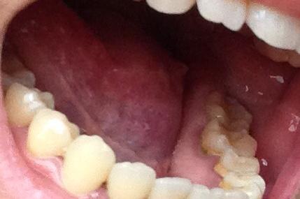 牙龈癌一般长在哪里图片
