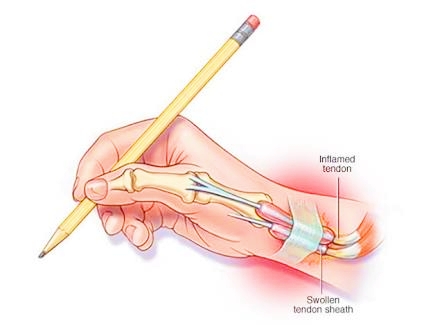 手腕腱鞘炎症狀圖片(長時間使用手機導致腕部腱鞘炎) - 赤虎壹號