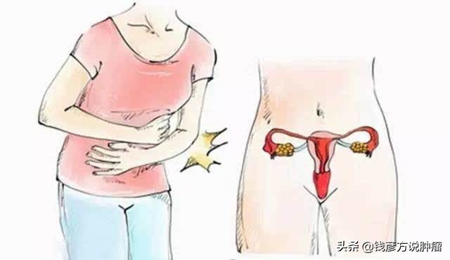 宫颈息肉早期，一般会出现3种症状，想要预防，生活中注意这3点