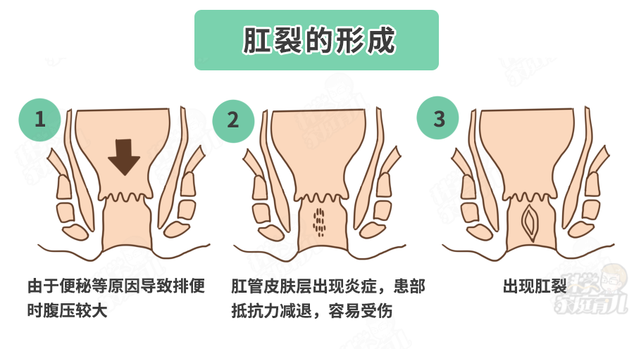 肛裂是什么样子的图片图片