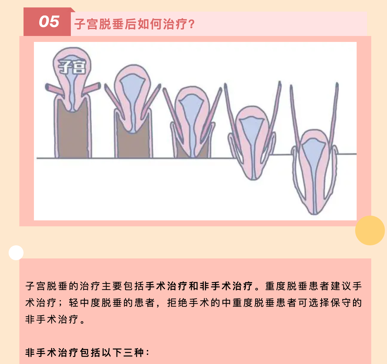 产后小腹总有下坠感，要警惕子宫脱垂啦