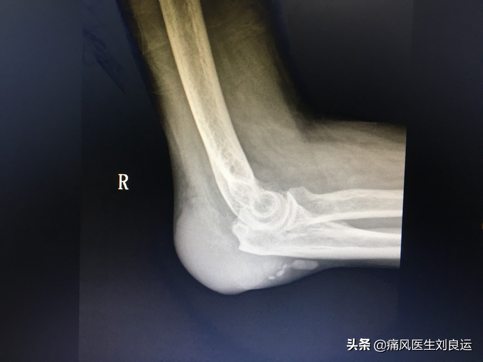 痛风石可以做手术取石吗？如何清除关节处尿酸盐结晶和积液？