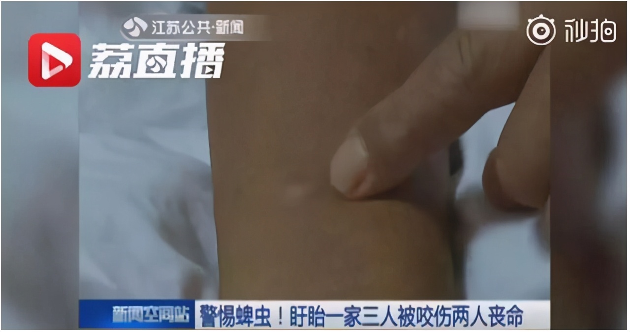 夏天户外千万小心这种夺命虫，被叮咬后如何处理？多数人不知道